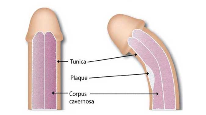 Penis Eğriliği