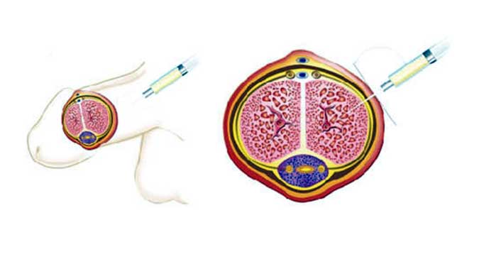 Stem Shot - Kök Hücre Transferi ile Penis Performansı Arttırma
