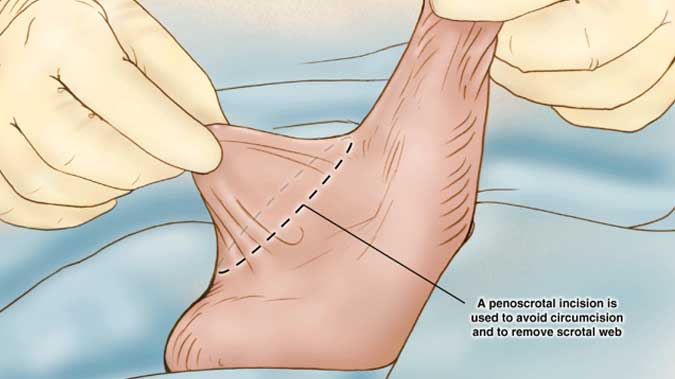 Skrotum Estetiği Cerrahisi