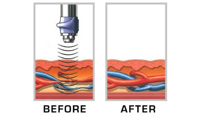 ESWT Shock Wave Therapy