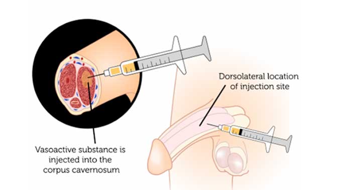 PRP injection to penis