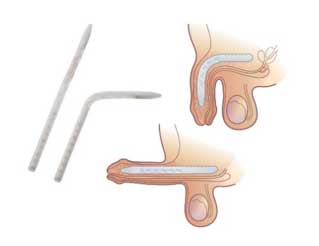 Bent Penile Prosthesis Surgery