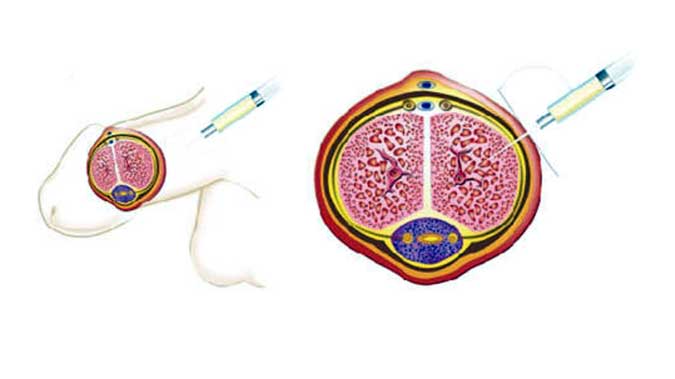 Stem Shot - Improving Penis Performance with Stem Cell Injection