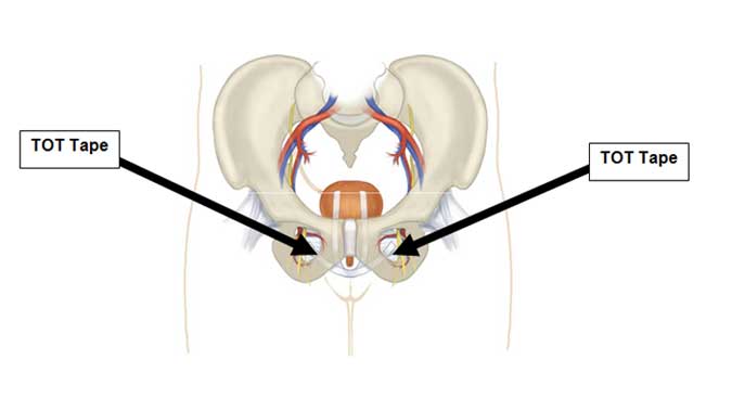 Urinary Incontinence Treatment