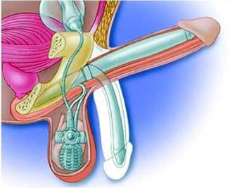 Inflatable Penile Prosthesis Surgery