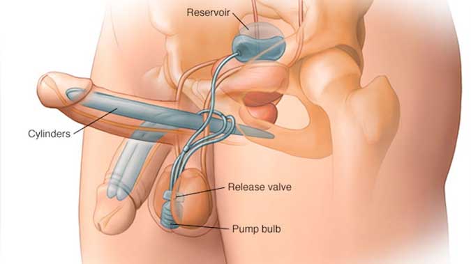 Penile Prosthesis